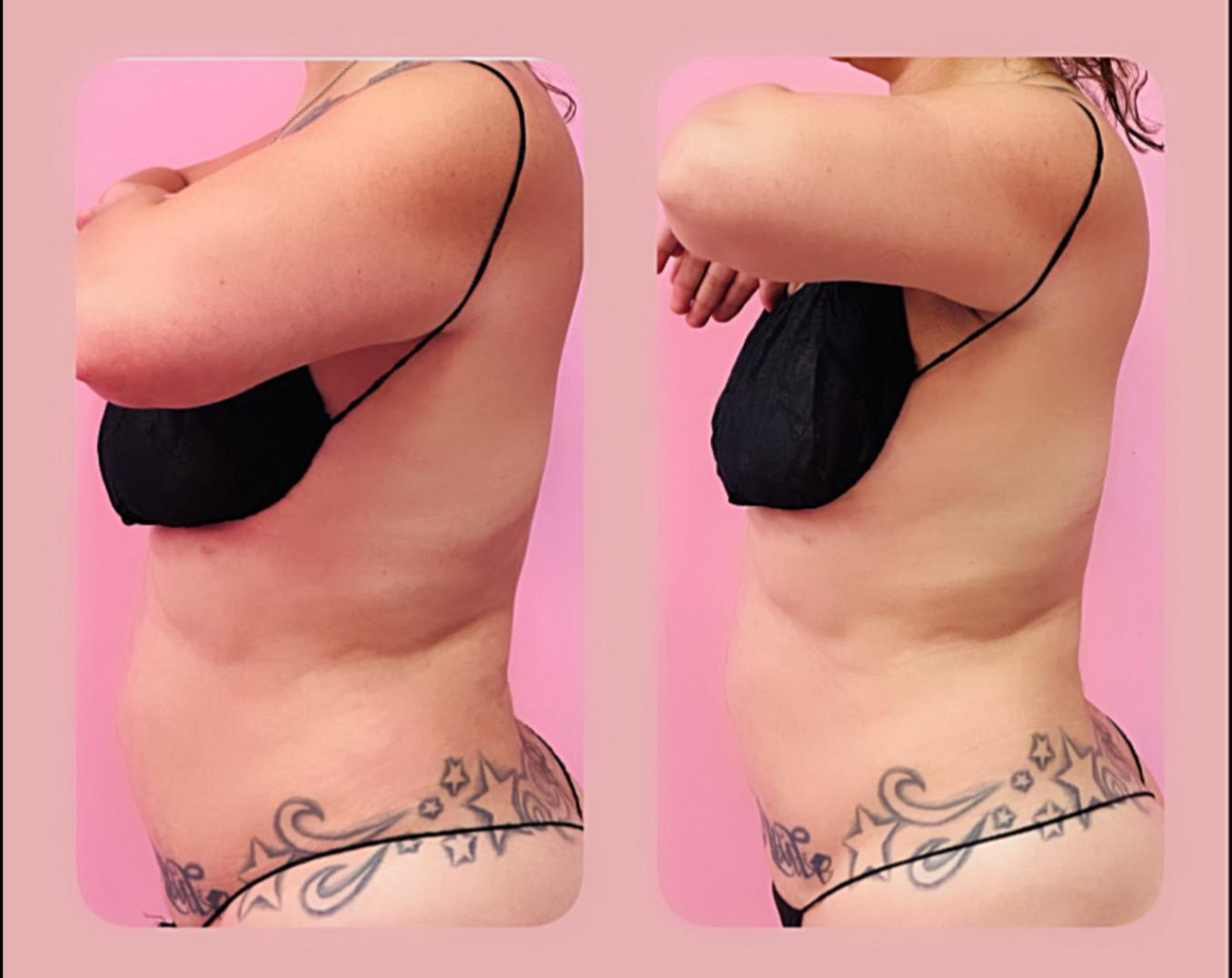 Body sculpting