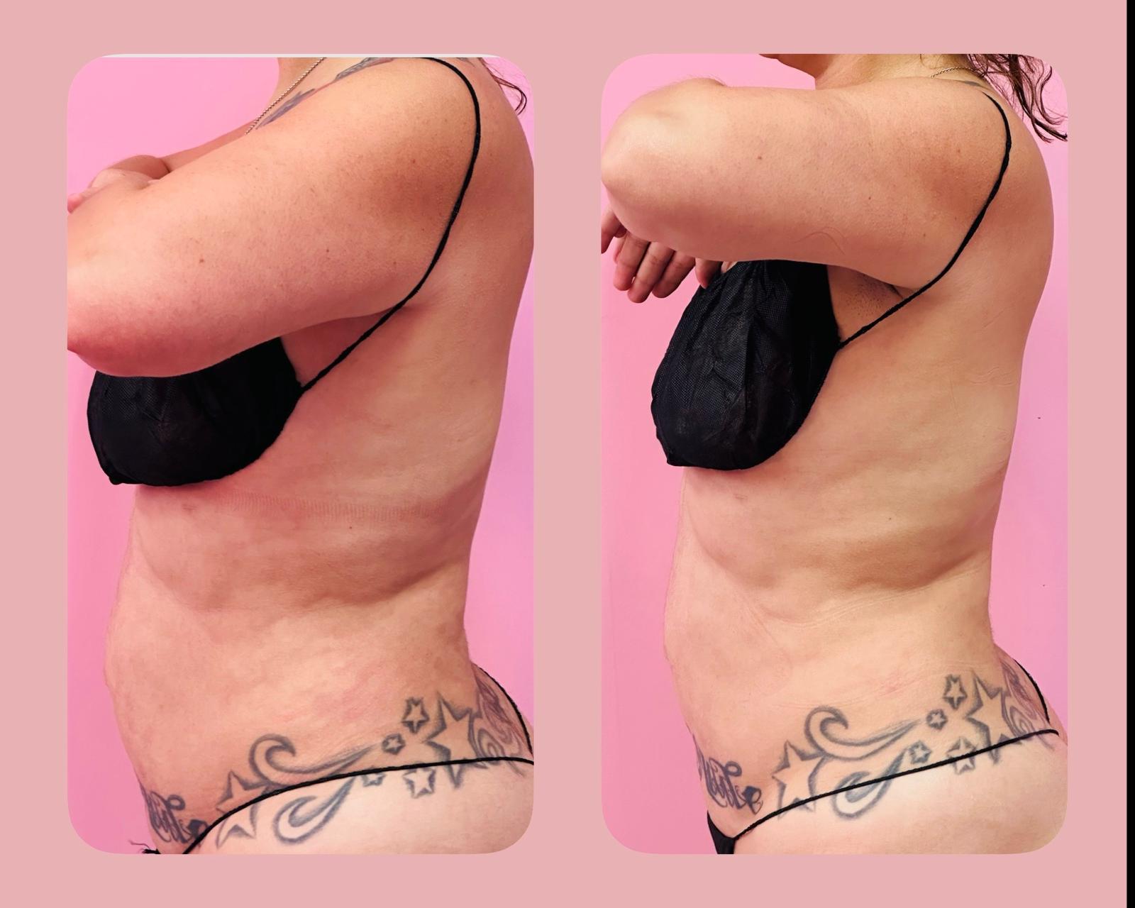 Body contouring