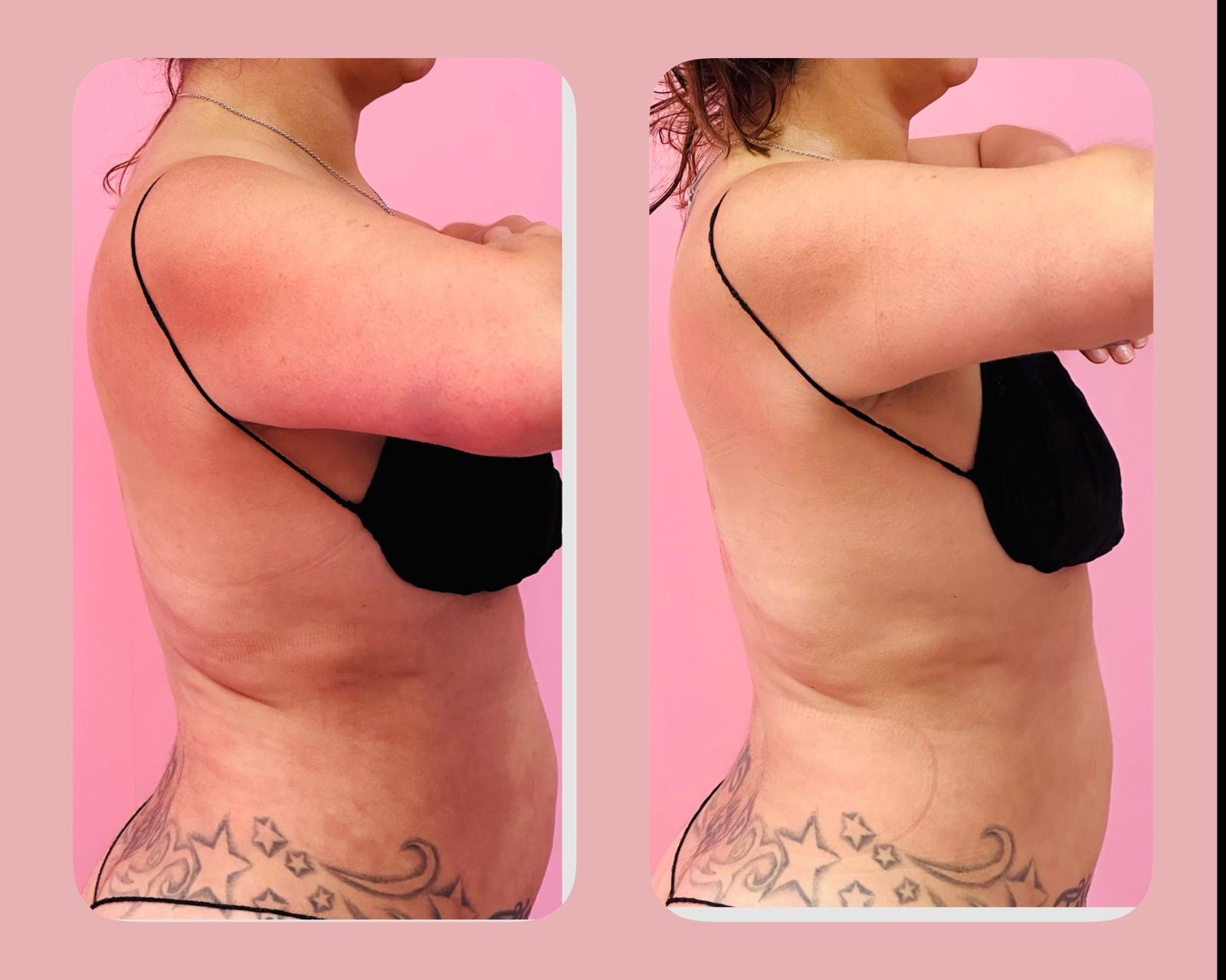 Body contouring