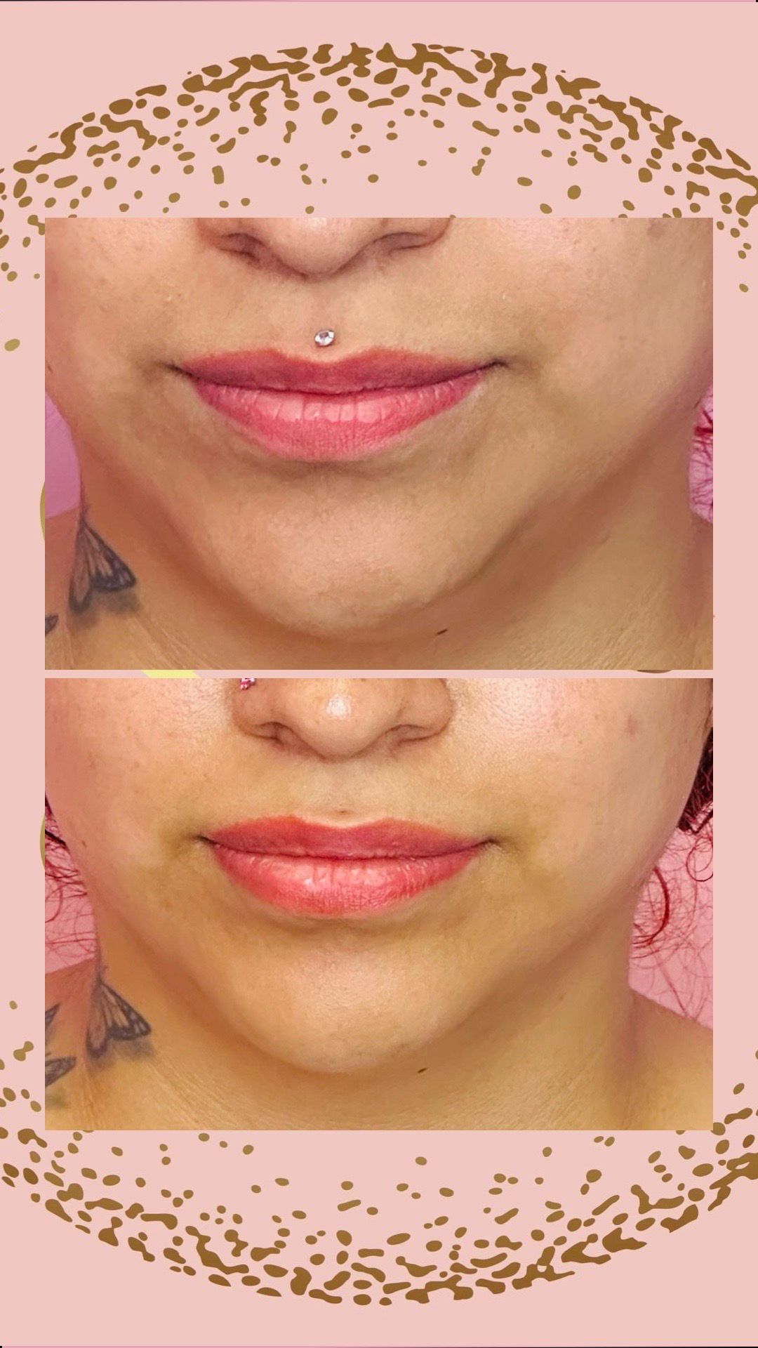 Chin reduction