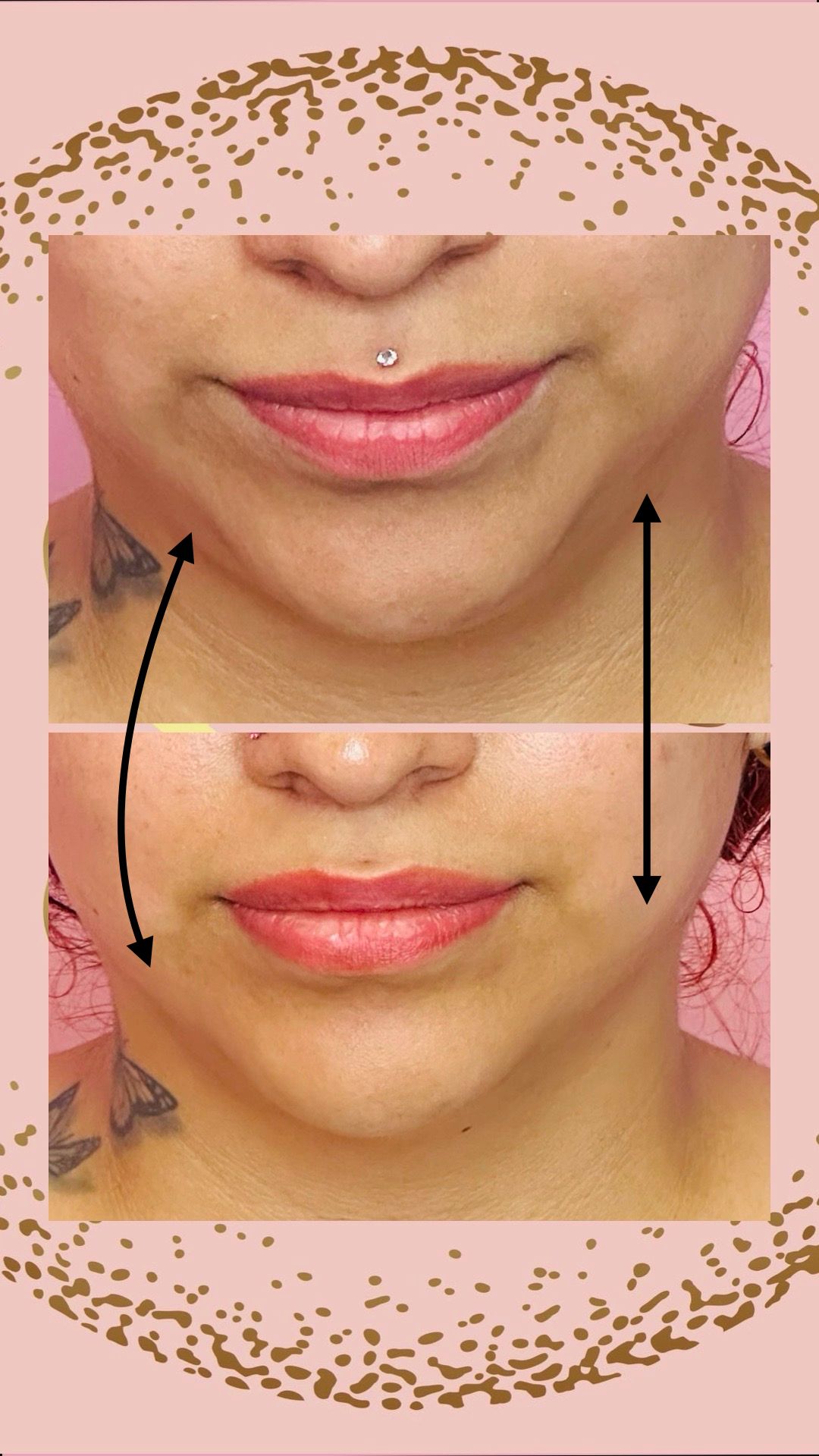 Chin reduction