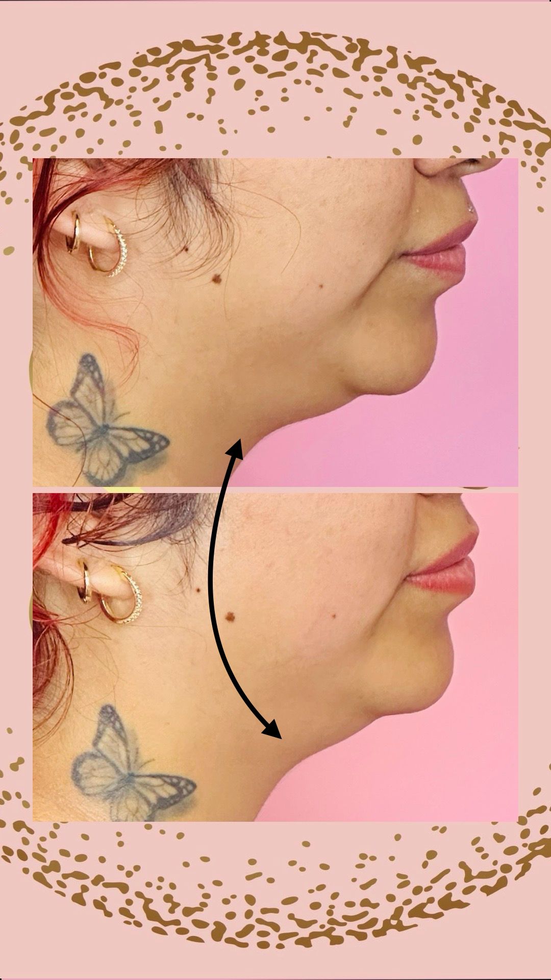Chin reduction