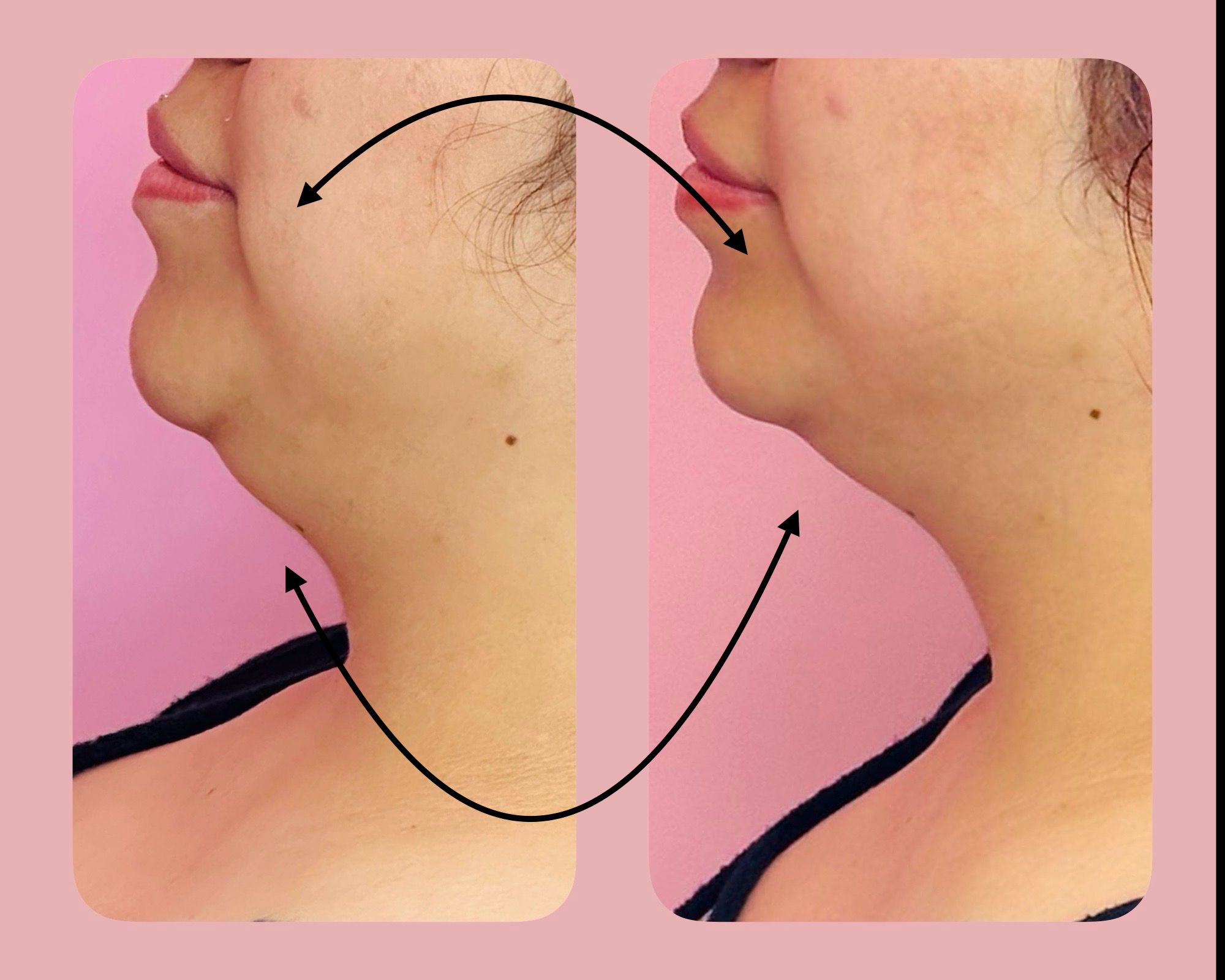 Chin reduction